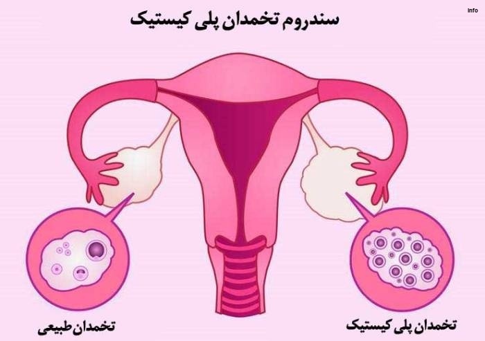 خواص آلبالو برای تنبلی تخمدان_6