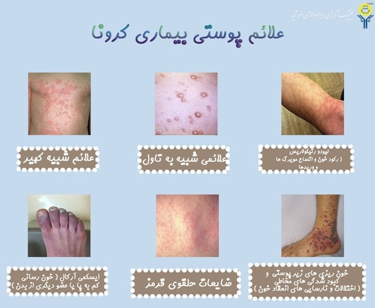 علائم ویروس شبه کرونا_5
