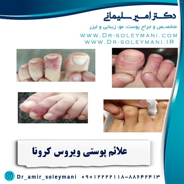 ویروس شبه کرونا چیست_5
