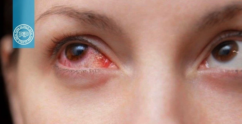 ویروس کرونا و قرمزی چشم_5