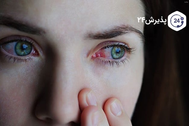 ویروس کرونا و قرمزی چشم_9