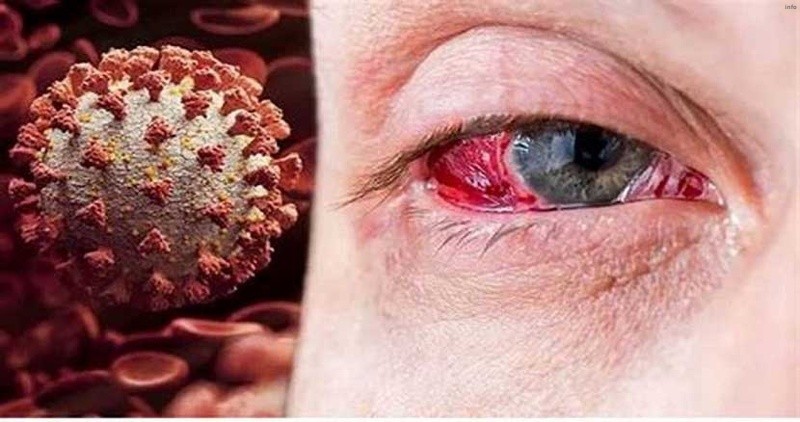 ویروس کرونا چشمی_1