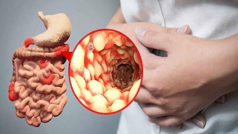 ویروس کرونا گوارشی_10